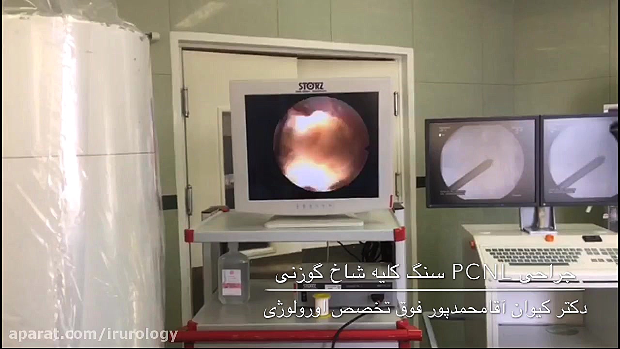 عمل جراحی سنگ کلیه به روش PCNL درمان جای جوش