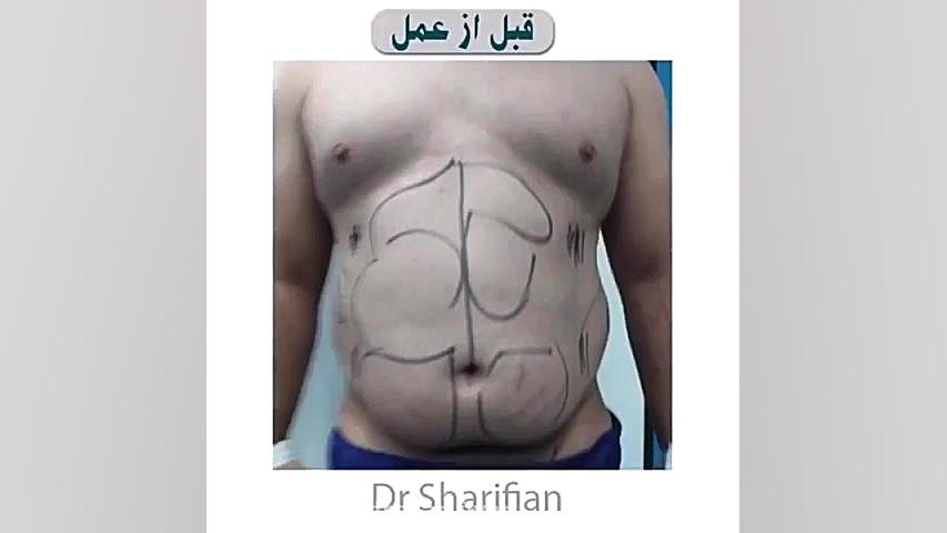لیپوماتیک شکم و پهلو و پشت بررسی اروماتاز