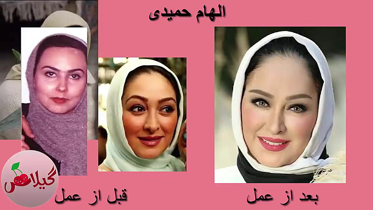 تصاویر قبل و بعد از عمل زیبایی بازیگران ایرانی کلینیک پوست
