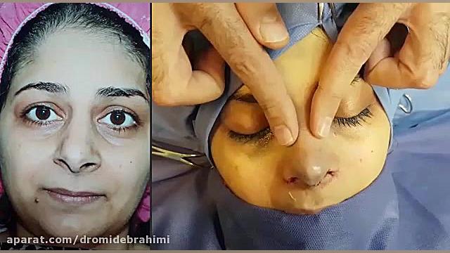 جراحی انحراف بینی توسط دکتر امید ابراهیمی بهترین جراح بینی دکتر امید ابراهیمی