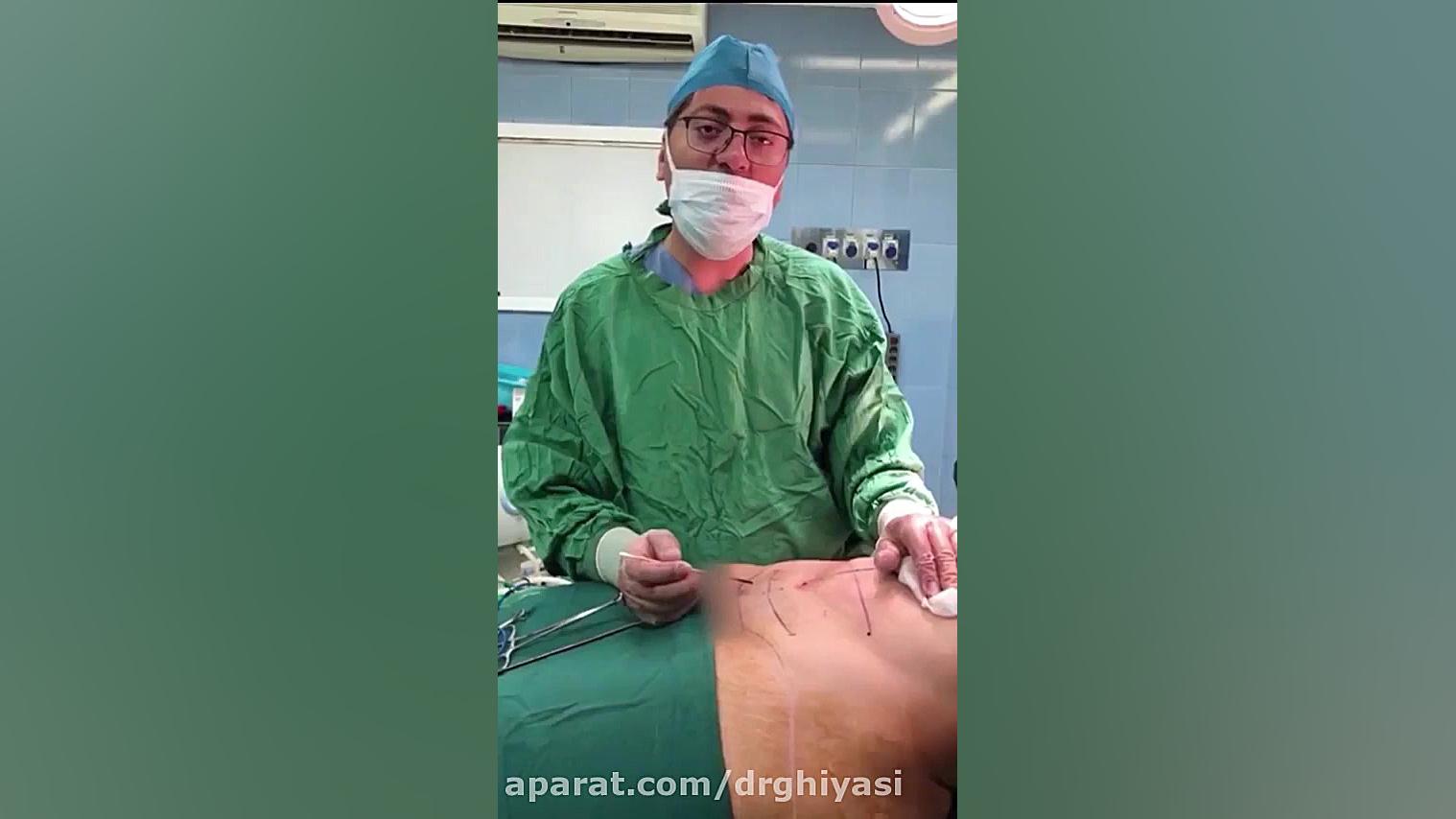 عمل جراحی مینی ابدومینوپلاستی دکتر سینا غیاثی حافظی