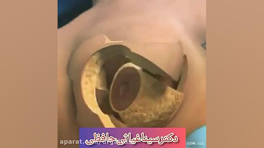 لیفت سینه دکتر سینا غیاثی حافظی