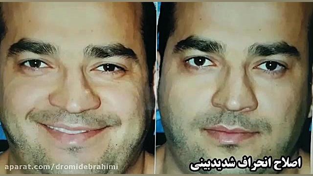 جراحی انحراف بینی توسط دکتر امید ابراهیمی بهترین جراح بینی دکتر امید ابراهیمی