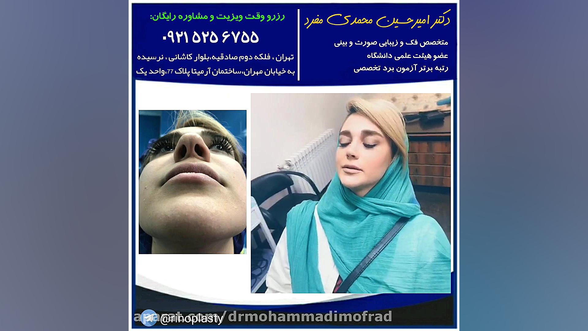 عمل زیبایی بینی (دکتر امیر حسین محمدی مفرد) دکتر امیر حسین محمدی مفرد