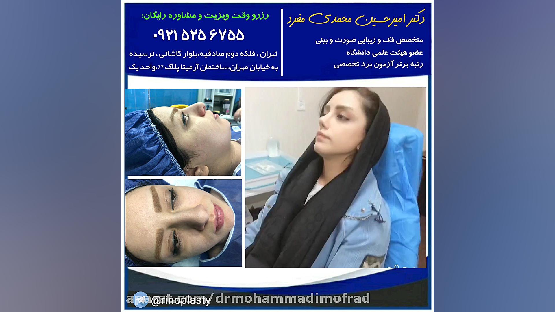 عمل زیبایی بینی استخوانی (دکتر امیر حسین محمدی مفرد) دکتر امیر حسین محمدی مفرد