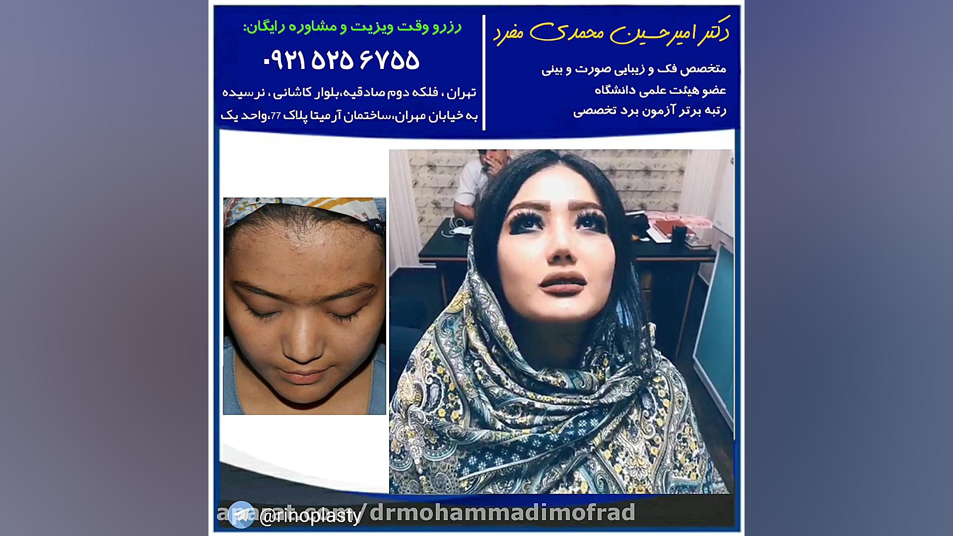 عمل زیبایی بینی (دکتر امیر حسین محمدی مفرد) دکتر امیر حسین محمدی مفرد
