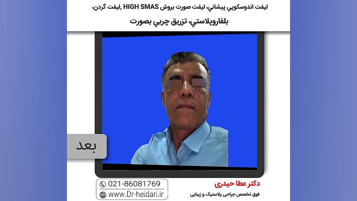 ليفت اندوسكوپي پيشاني، ليفت صورت و گردن و بلفاروپلاستی ویروس‌شناسی انسانی
