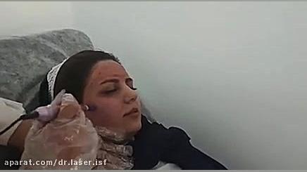 مزو میکرونیدلینگ و جوانسازی پوست یکی از بى عارضه ترین روشهای کلاژن سازی رفع غبغب