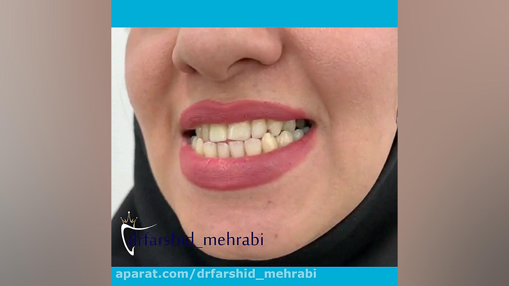 لمینت دندان| کامپوزیت دندان|لمینیت بیماری سندرم فریمن شلدون