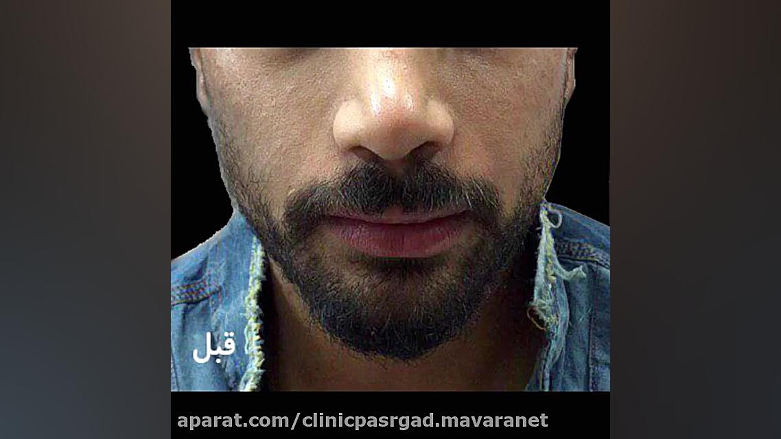 زاویه سازی صورت در مردان دستگاه Cell Sorter