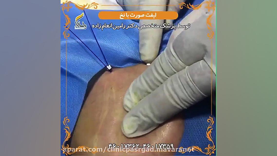 فیلم لیفت صورت با نخ در ایران هایپرپاراتیروئیدیسم