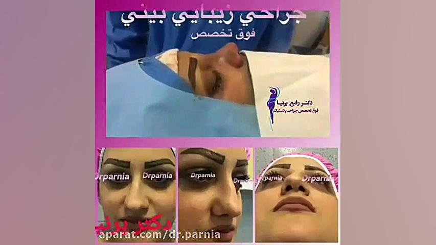 عمل بینی گوشتی دکتر رفیع پرنیا فوق تخصص پلاستیک