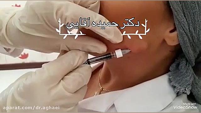 فیلم زاویه سازی فک با تزریق ژل دکتر حمیده آقایی