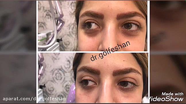 رفع گودی و تیرگی زیر چشم با تزریق فیلر ( دکتر گلفشان متخصص پوست و مو) دکتر عاطفه گلفشان، متخصص پوست مو و لیزر درمانی