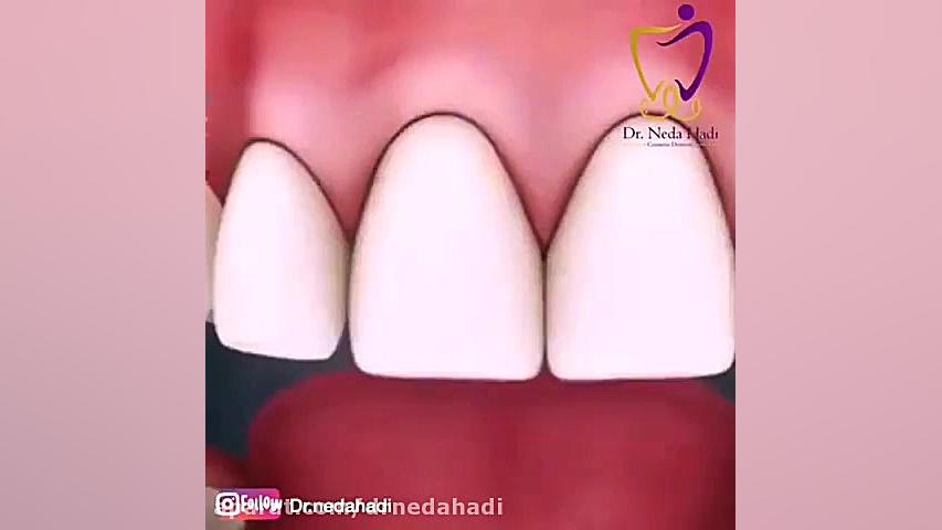 روش استفاده صحیح از نخ دندان دکتر ندا هادی-دندانپزشک زیبایی