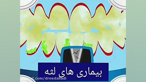 مهم ترین بیماری های لثه دکتر ندا هادی-دندانپزشک زیبایی
