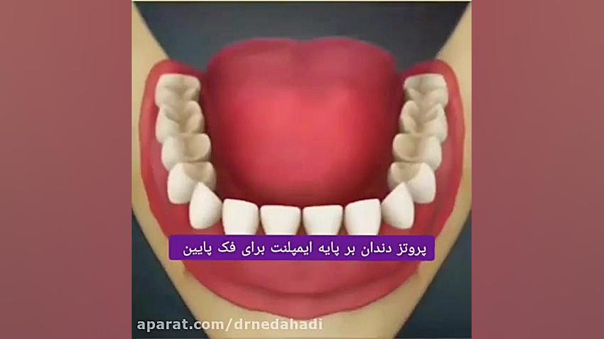 پروتز دندان بر پایه ایمپلنت برای فک پایین دکتر ندا هادی-دندانپزشک زیبایی