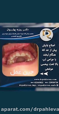 جراحی اصلاح لبخند