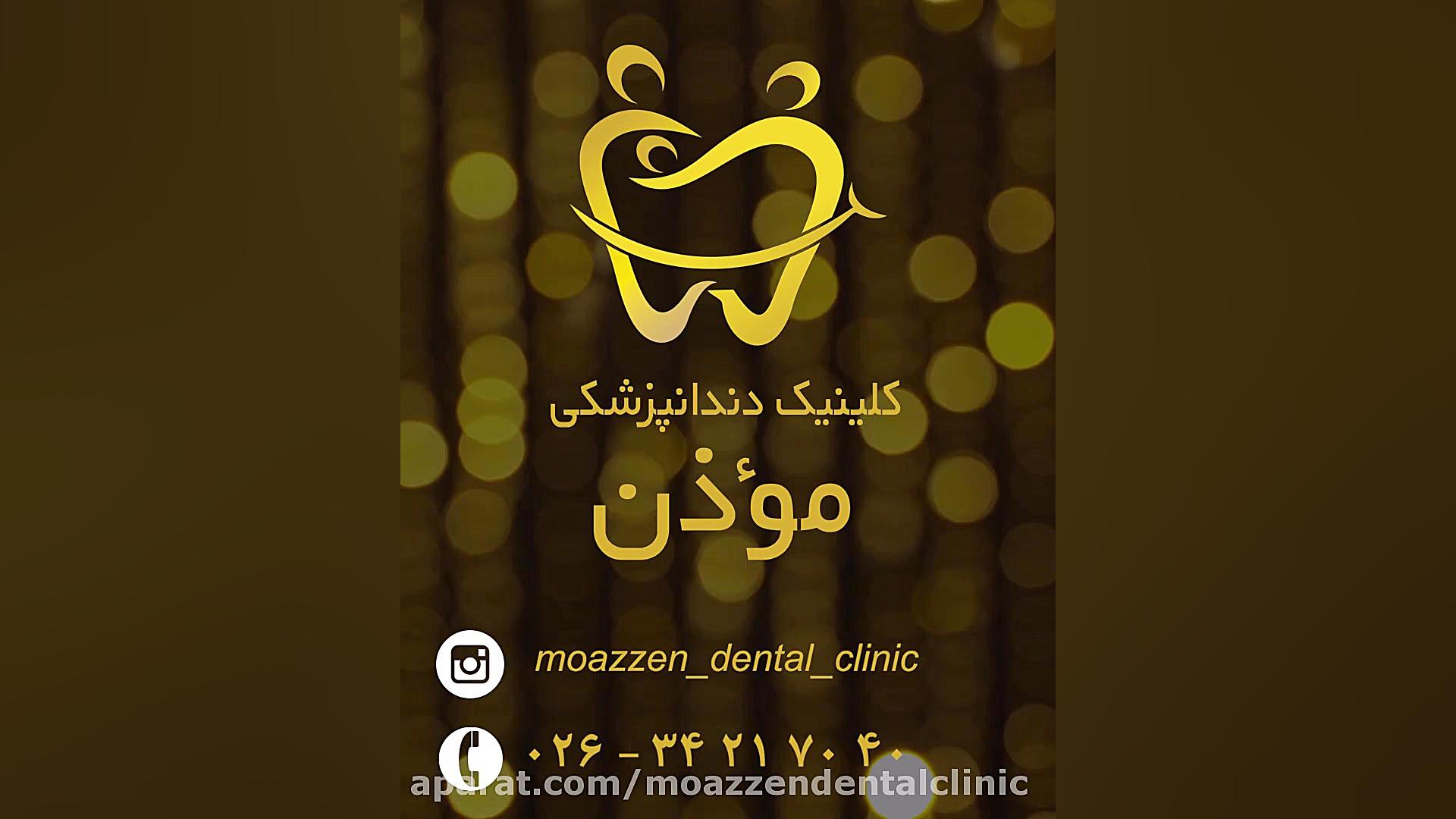 اصلاح خط لبخند کودک کلینیک دندانپزشکی موذن