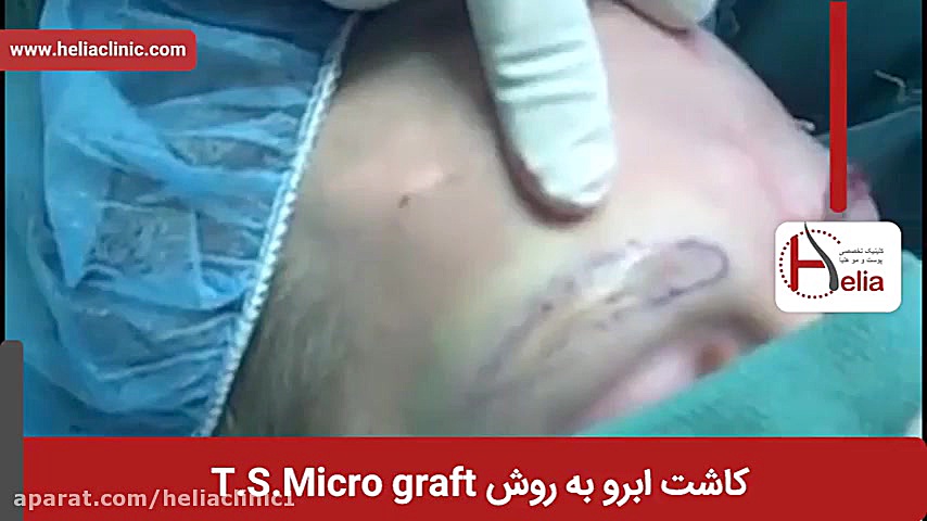 فیلم کاشت ابرو | کلینیک پوست و مو هلیا | شماره 2 | 02179547 عمل زیبایی