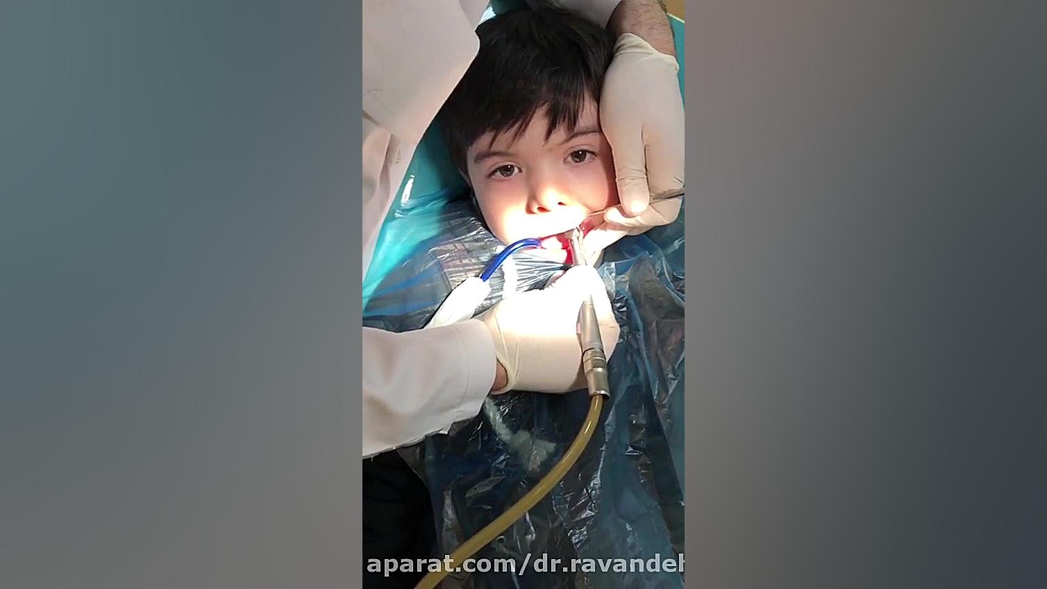 دکتر نوید رونده، دندانپزشکی کودکان بدون بیهوشی CUT&Tag