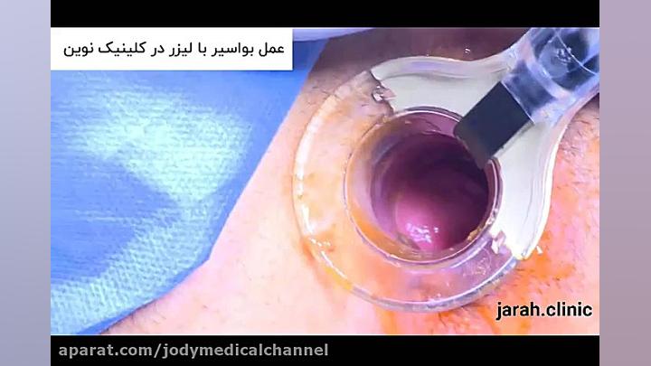 فیلم عمل بواسیر با لیزر در کلینیک نوین Organoid Viability Test
