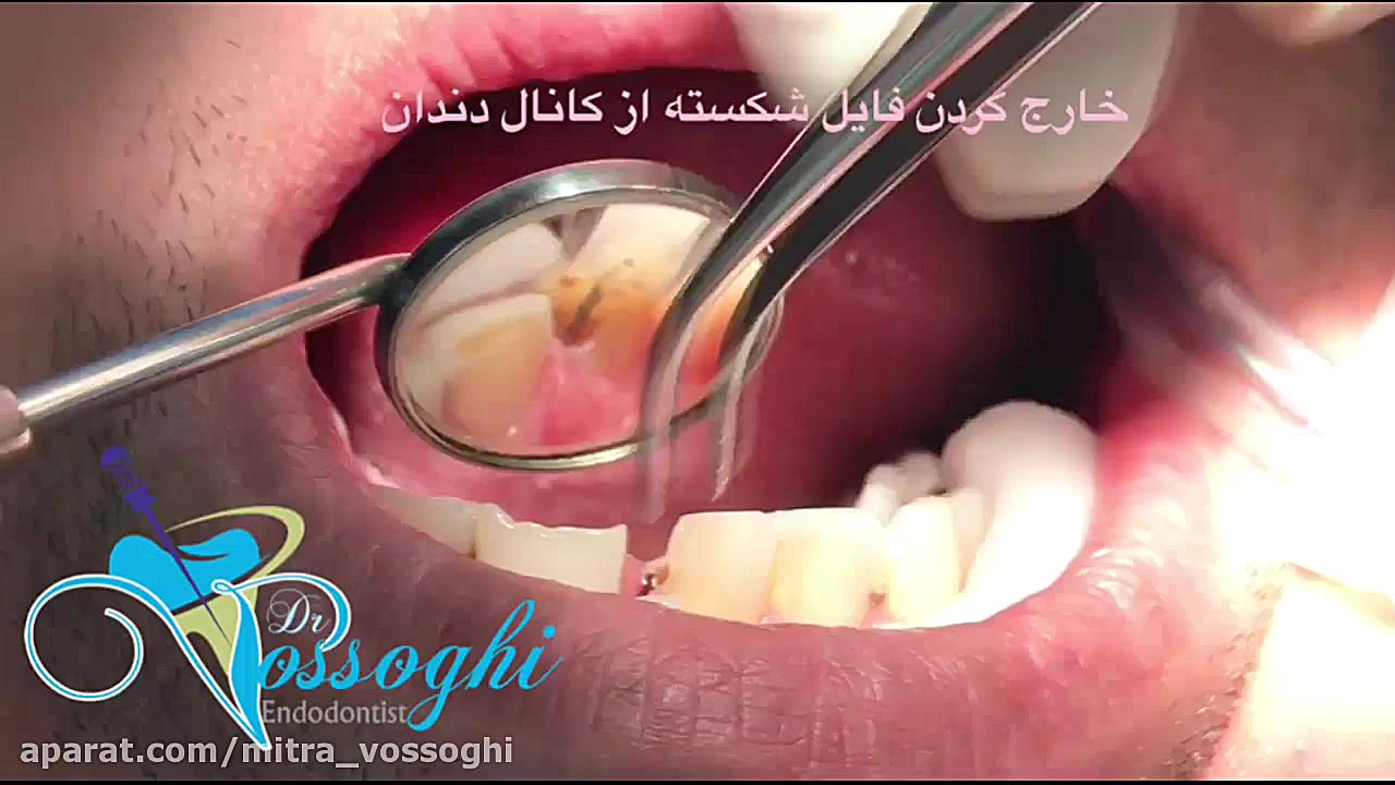 خارج کردن فایل شکسته از کانال دندان دکتر میترا وثوقی