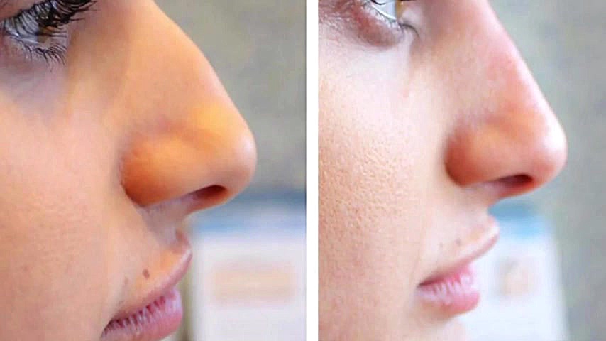 آیا کوچک کردن بینی با تزریق ژل واقعیت دارد؟ دستگاه پلاسمای سرد