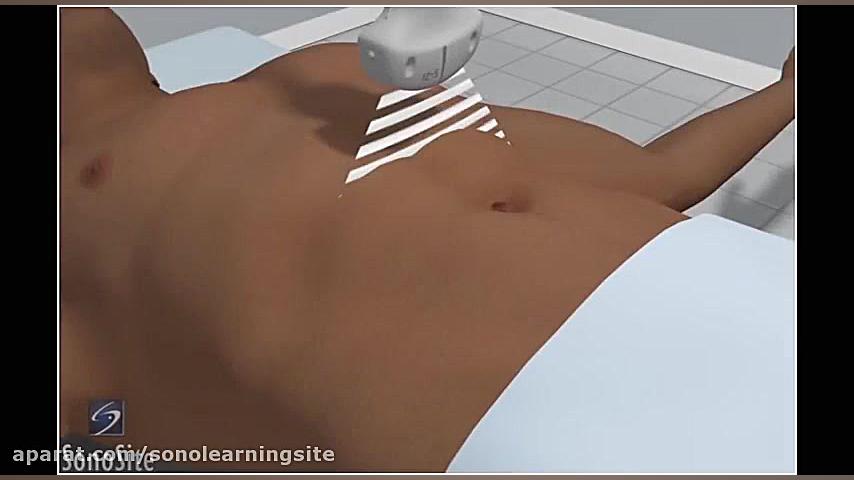 3D How to- Abdominal Aorta Ultrasound - SonoSite Ultrasound مد روز