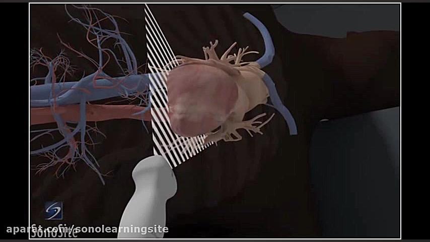 3D How To- Apical 4-Chamber View, Echocardiography - SonoSite Ultrasound پروتز دندان