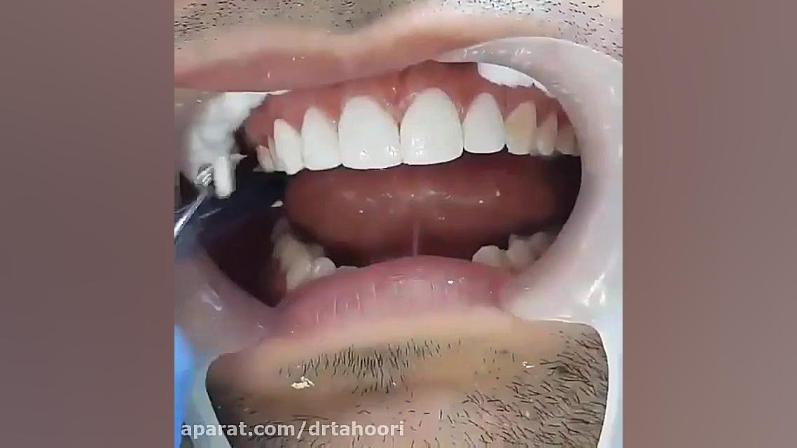 کامپوزیت ونیر-مرکز دندانپزشکی فوق تخصص ایمپلنت و زیبایی پردیس 88676014 کاپوت سکودانئوم