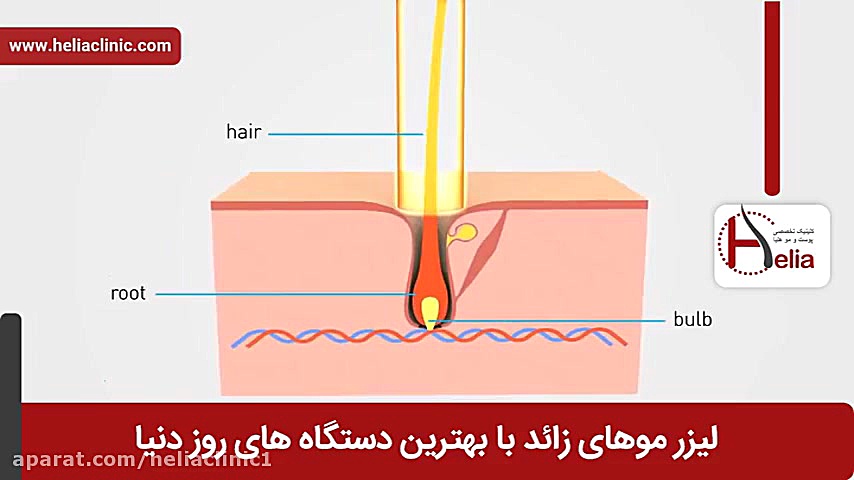 فیلم لیزر موهای زائد | کلینیک پوست و مو هلیا | شماره 2 | 02179547 Super Resolution Microscopy