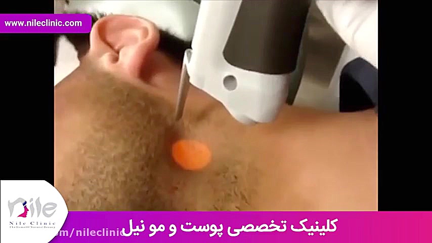 لیزر موهای زائد | فیلم لیزر موهای زائد | کلینیک پوست و مو نیل | شماره 3 جراحی گوش