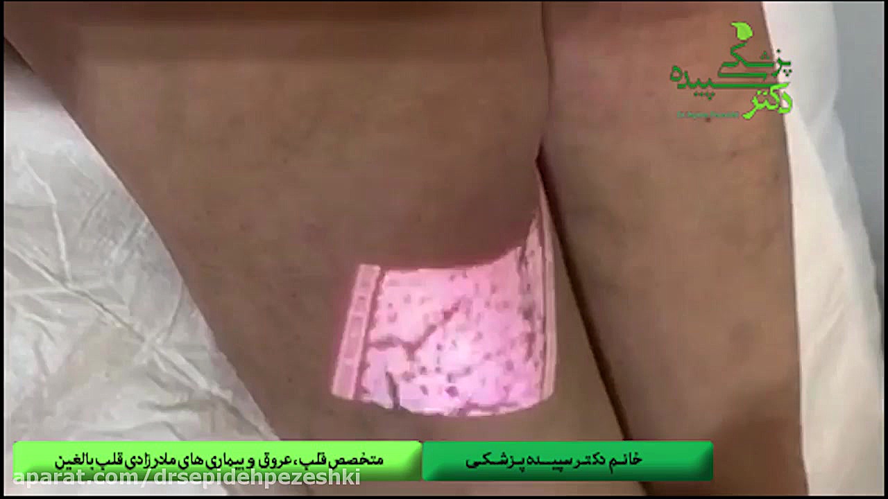 تعیین دقیق محل عروق واریسی، با تکنیک رگ یاب پیشرفته توسط دکتر سپیده پزشکی ماستوسیتوز