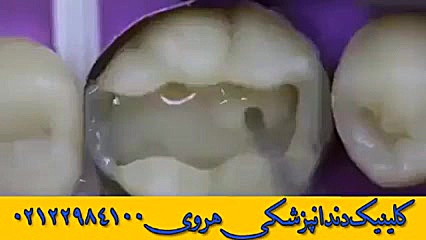 ترمیم هنرمندانه دندان با مواد همرنگ دندان تزریق چربی