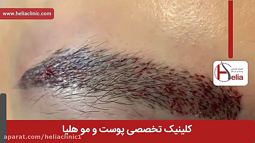 فیلم کاشت ابرو | کلینیک پوست و مو هلیا | شماره 6 | 02179547 دندانپزشکی کودکان