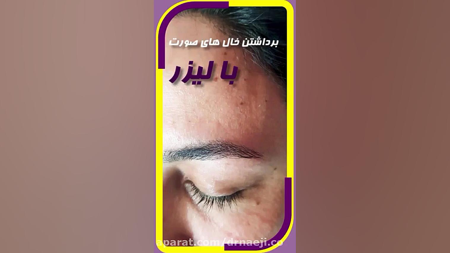 بهترین راه برداشتن خال های صورت دکتر صدیقه نائیجی | متخصص پوست و مو در قم