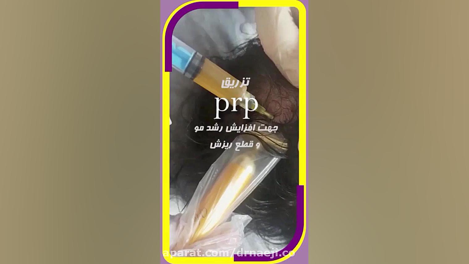 افزایش و تقویت رشد مو با تزریقPRP دکتر صدیقه نائیجی | متخصص پوست و مو در قم