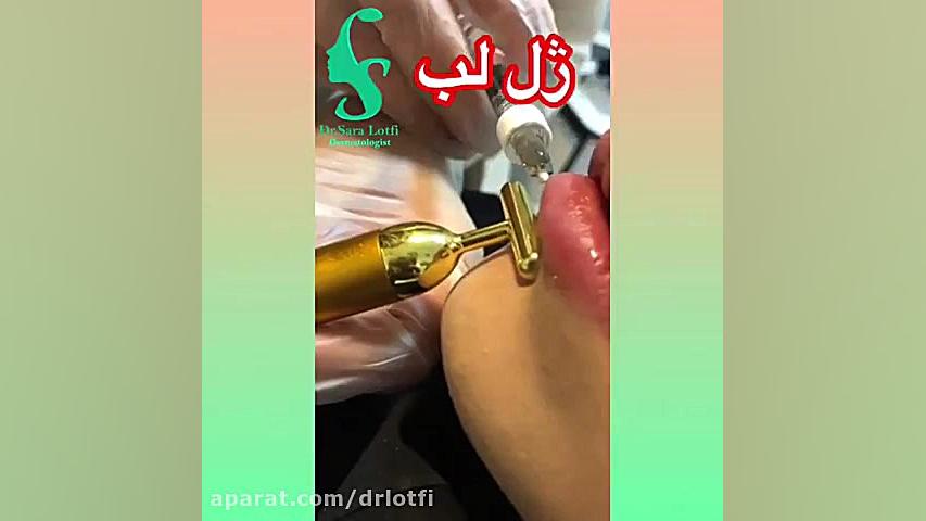 فیلم تزریق ژل لب دکتر سار ا لطفی