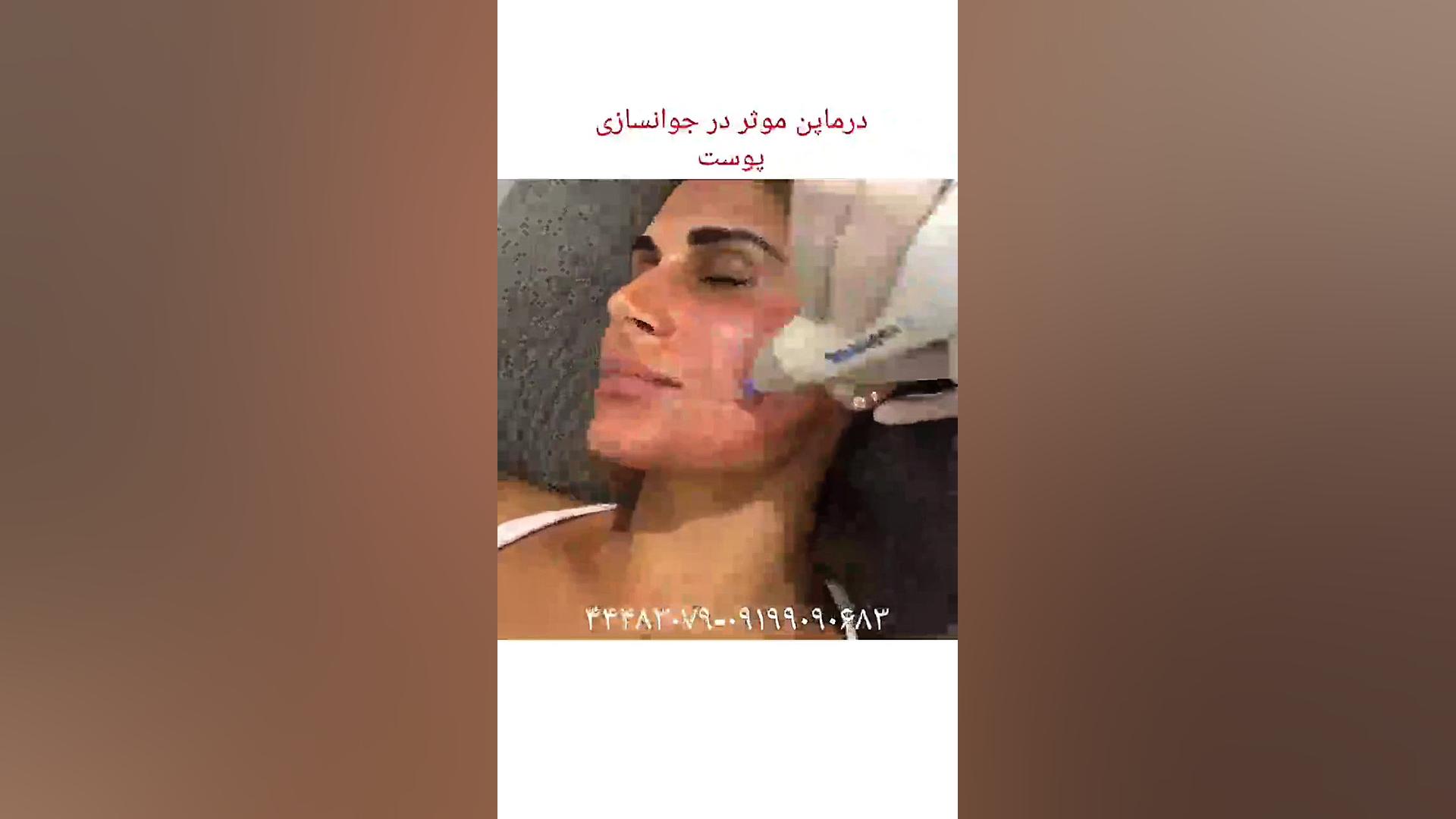 پوستی شفاف با درماپن یا میکرونیدلینگ Anti-CCP