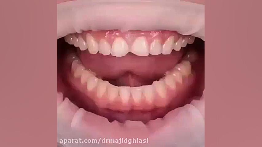 ترمیم شکستگی دندان-دکترمجیدقیاسی دندانپزشک زیبایی مشهد جراحی لثه