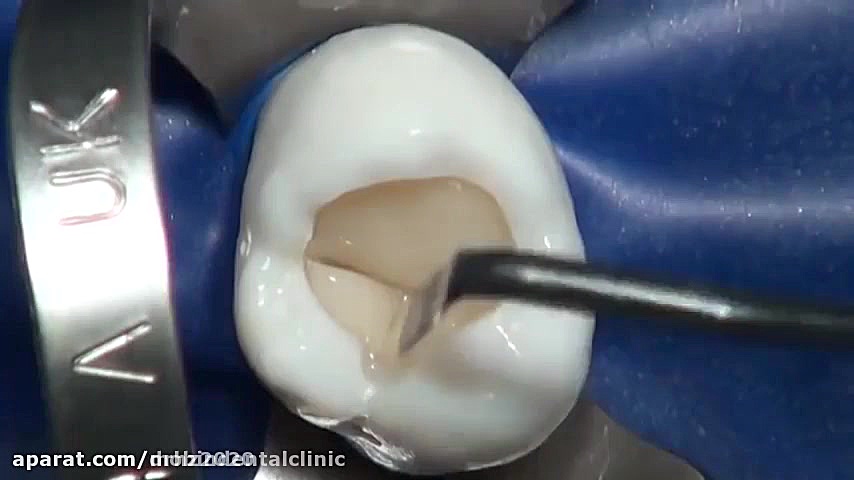 ترمیم و پرکردن دندان ریبوسیکلیب