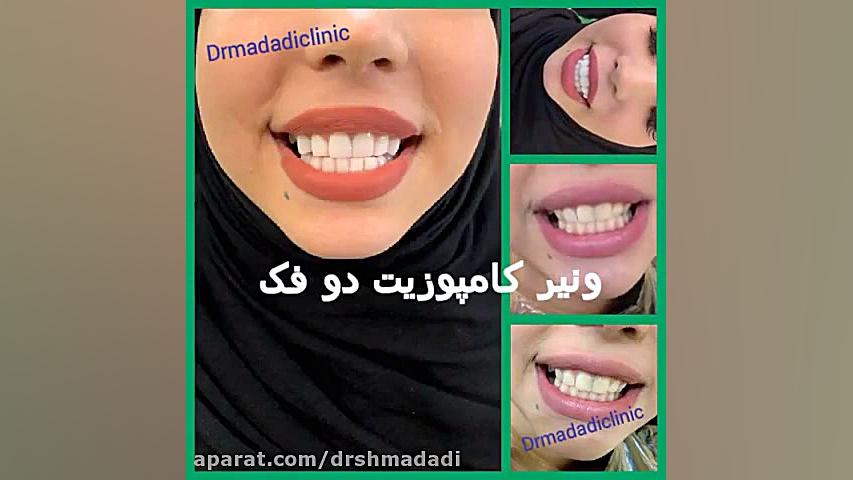 نمونه کار کامپوزیت ونیر گالکانی زوماب