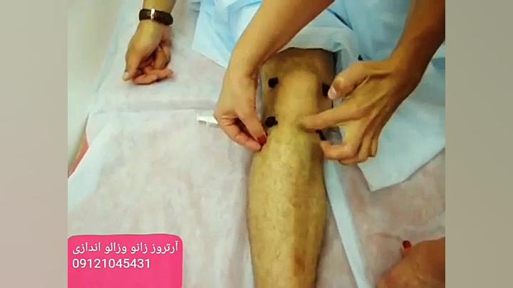زالو درمانی آرتروز و ترمیم لمینت