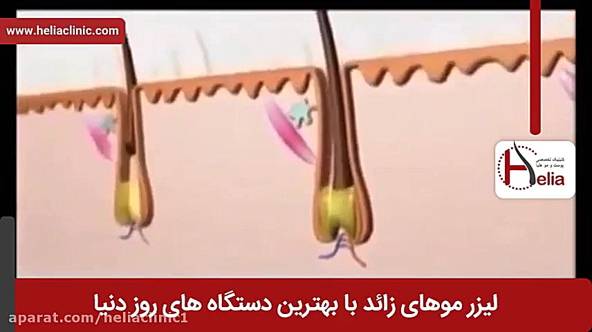 فیلم لیزر موهای زائد | کلینیک پوست و مو هلیا | شماره 5 | 02179547 دیسکرازی خون