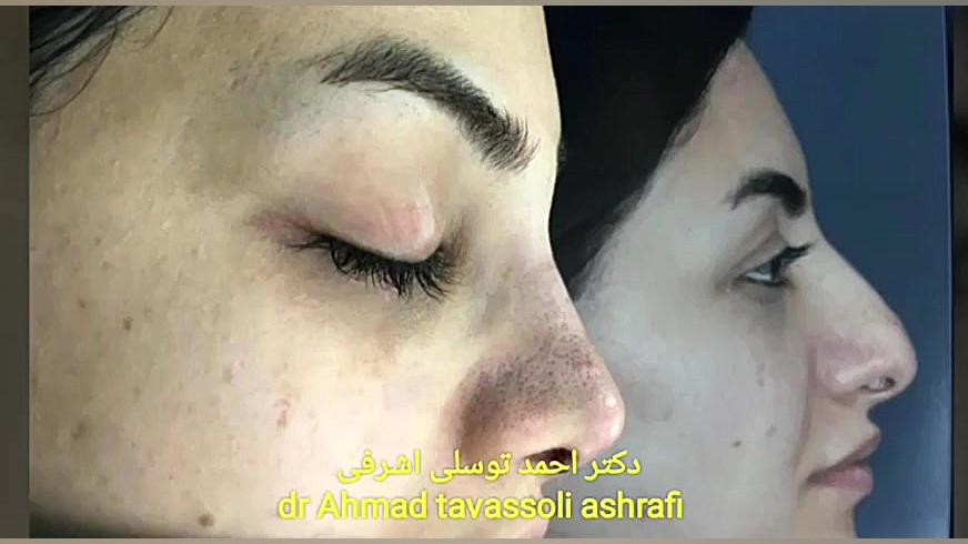 دکتر احمد توسلی اشرفی جراحی بینی دکتر احمد توسلی اشرفی