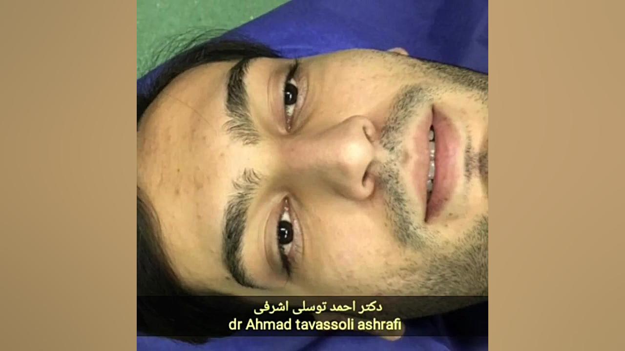 دکتر احمد توسلی اشرفی جراحی بینی دکتر احمد توسلی اشرفی