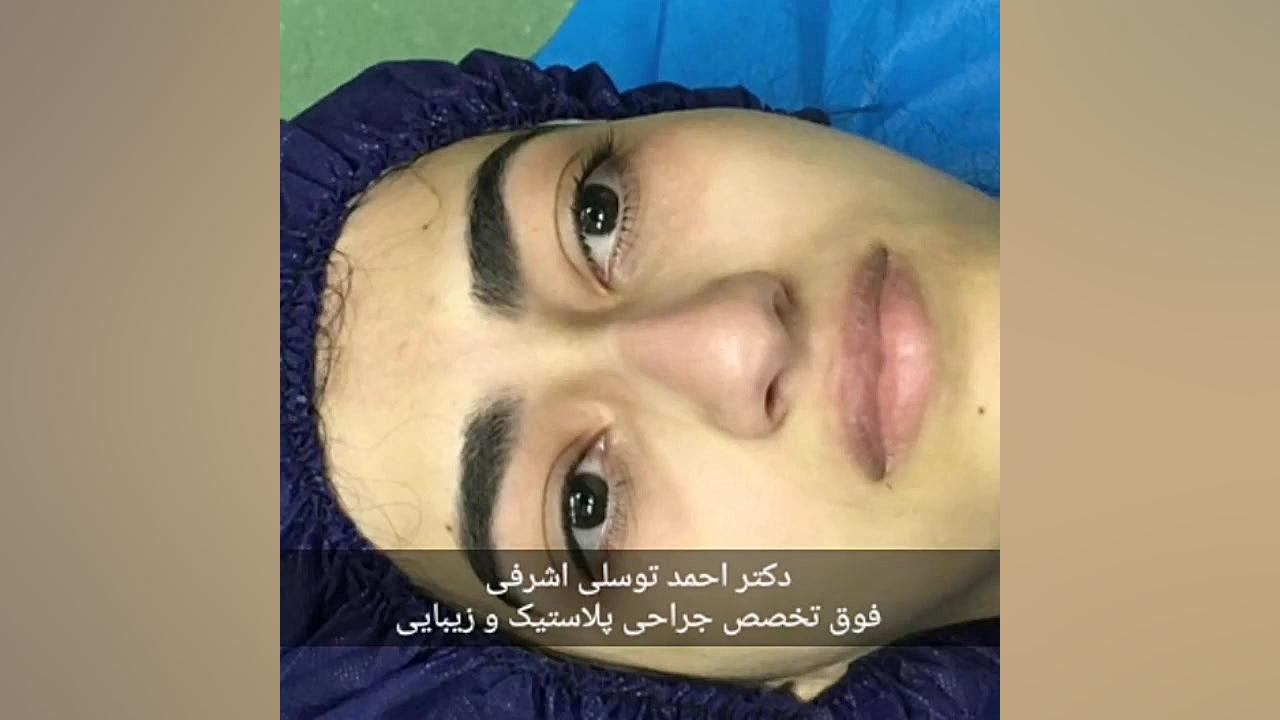 جراحی زیبایی بینی جراحی بینی دکتر احمد توسلی اشرفی