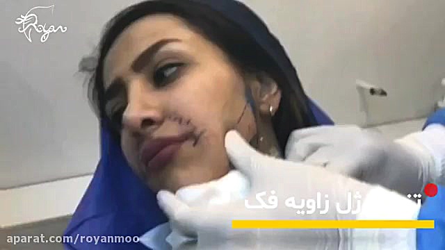 زاویه سازی و فرم دهی فک با تزریق ژل-کلینیک رایان سلامت تست کورتیزول دیورنال