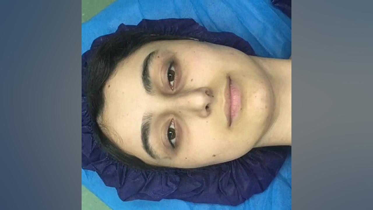 عمل زیبایی بینی جراحی بینی دکتر احمد توسلی اشرفی